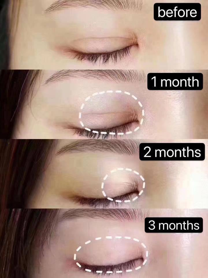 Dermatix - Silicone gel for scar reduction - Lemonbaby