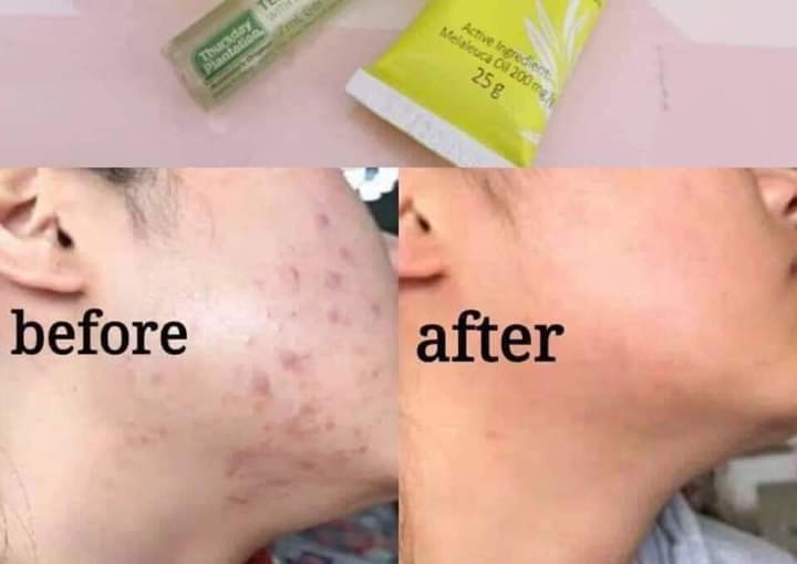 Thursday Plantation Tea Tree gel - Lemonbaby